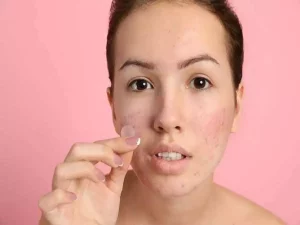 ¿Cómo funcionan y cómo se utilizan los ‘pimple patches’?